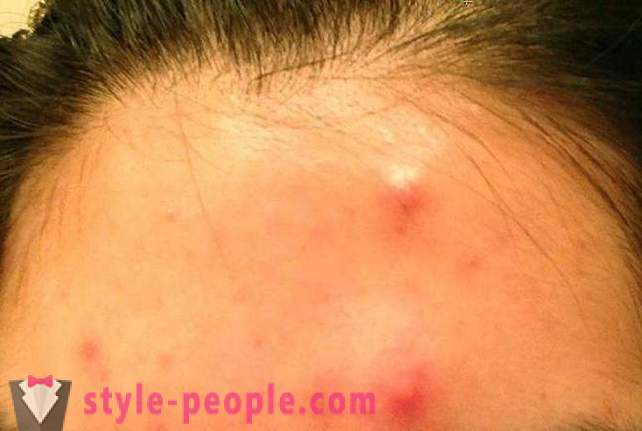 Quant à la nuit pour se débarrasser de l'acné à la maison?