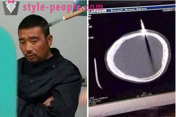 Un homme chinois avec un couteau dans sa tête, il est allé chez le médecin