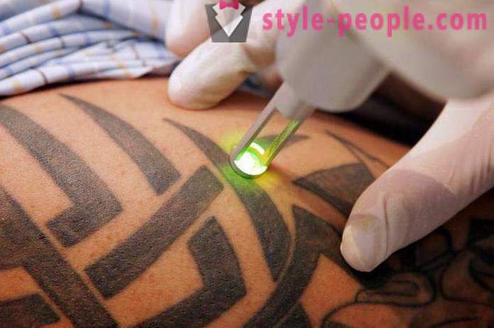 L'épilation au laser tatouage. la revue