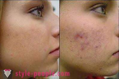 Vous voulez savoir comment faire pour supprimer les traces de boutons sur votre visage?