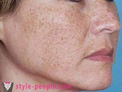 Les taches brunes sur le visage: les causes et la lutte contre les